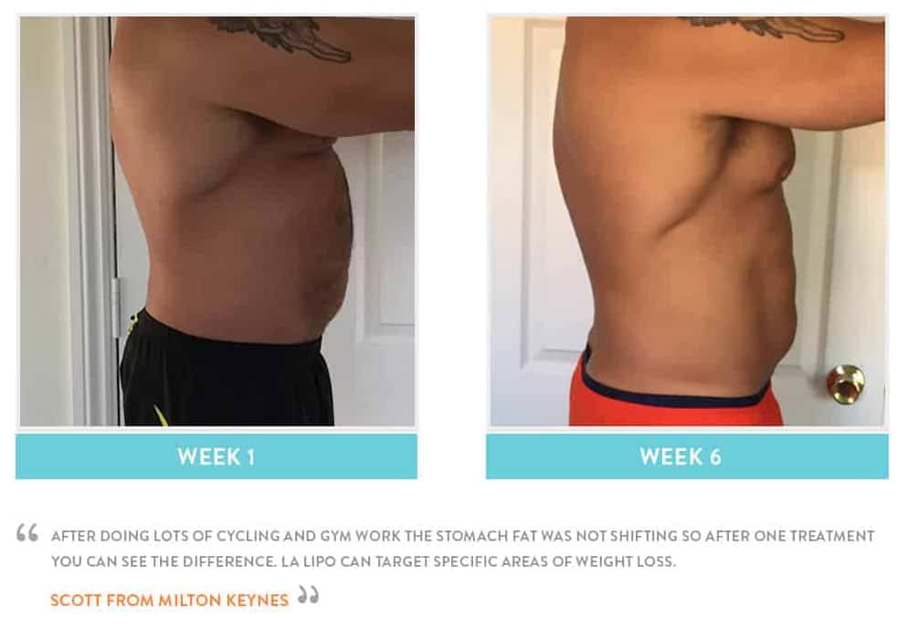 Before & After Stomach Fat Chiswick