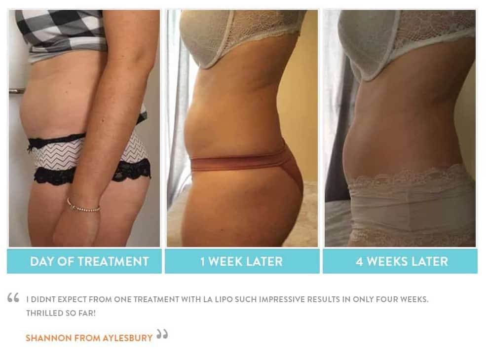 before, Cryolipolysis Chiswick