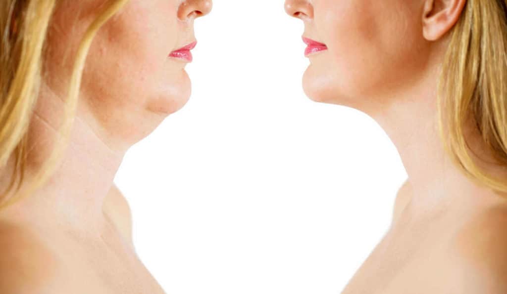 Double Chin treatment Chiswick before and after results