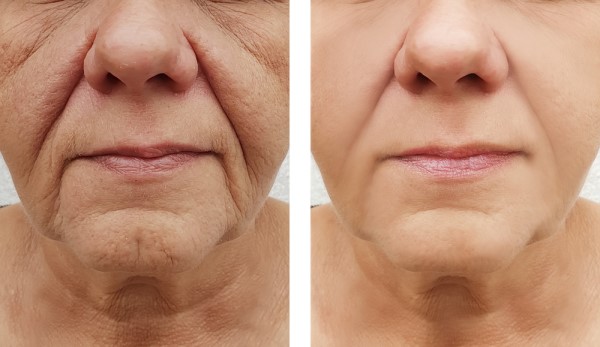 Learn more about Morpheus8 Treatment Chiswick today!