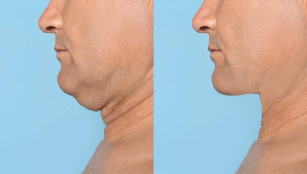Which Non-Surgical Treatments Work Best for Jowls and Loose Skin Chiswick?