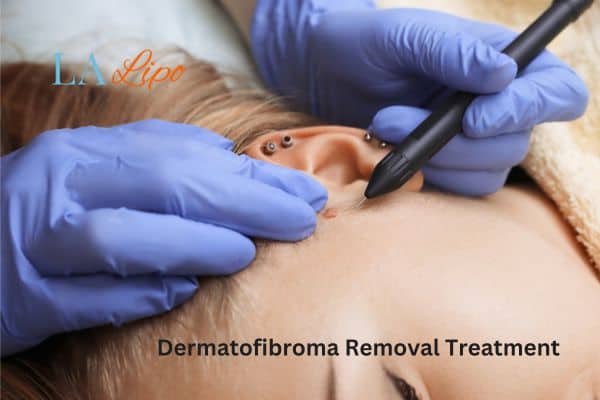 Dermatofibroma Removal Treatment Chiswick