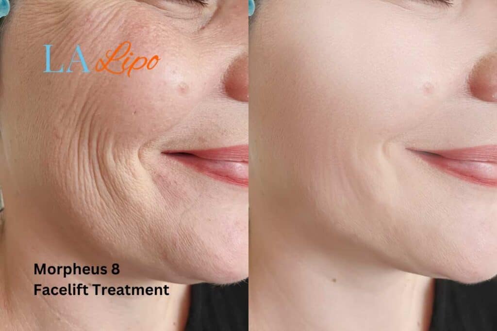 Morpheus8 Treatment Chiswick for flawless skin! Call us today!