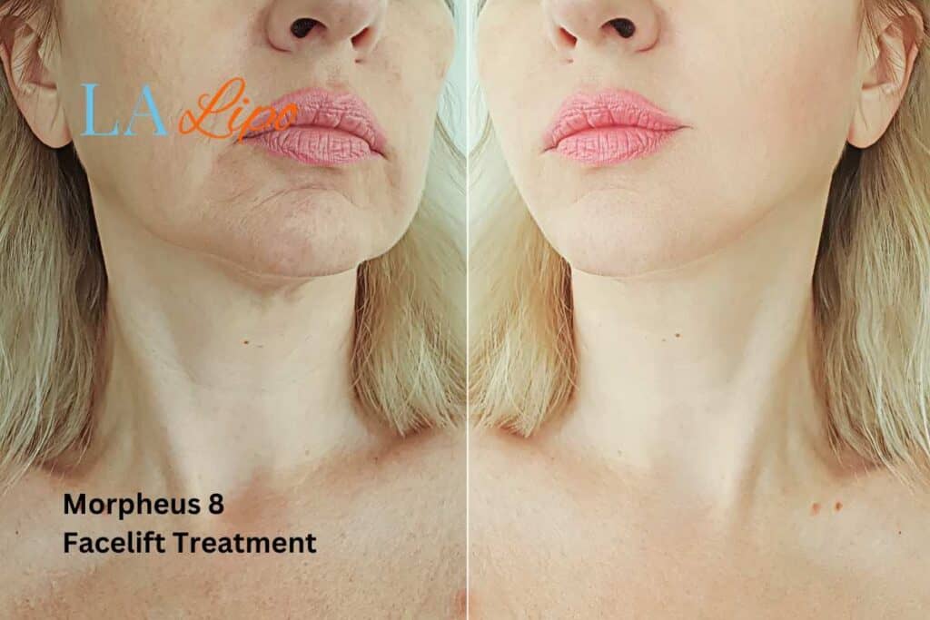 Turn back time with Morpheus8 Treatment Chiswick