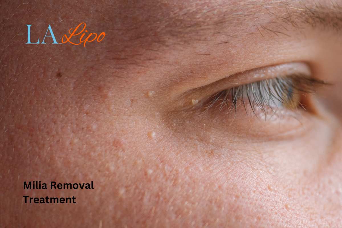 Cryopen Milia Removal: Is It the Easiest and Safest Option Chiswick?