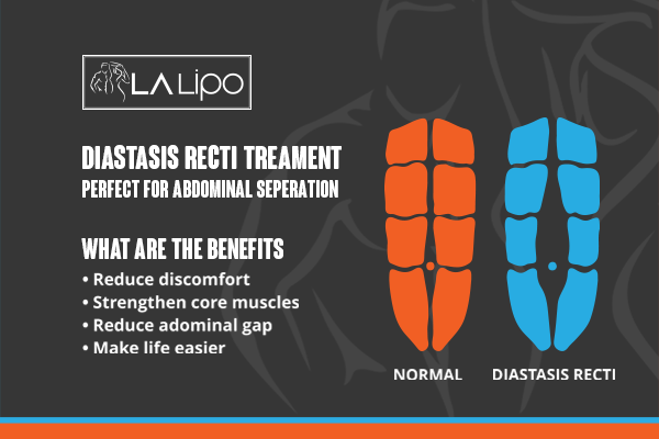 diastasis recti treatment