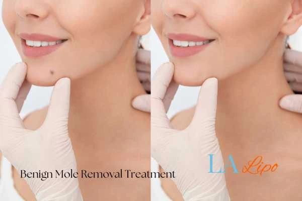 woman's before and after mole removal Chiswick results