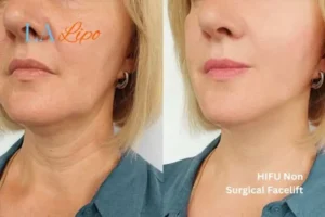 hi-fu for wrinkles Chiswick before and after results