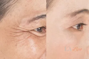 Before and after results of woman - HI-fu wrinkles reduction treatment Chiswick