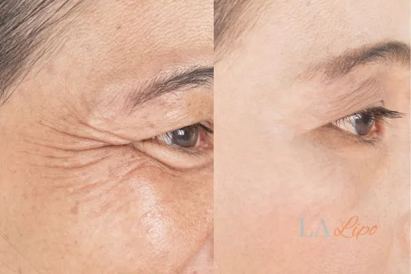 Before and after results of woman - HI-fu wrinkles reduction treatment Chiswick