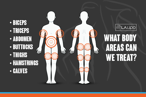 Graphic to show areas you can have LA-EMS Body Sculpting Chiswick treatment.