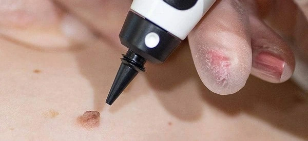 skin tag removal using cryopen Chiswick
