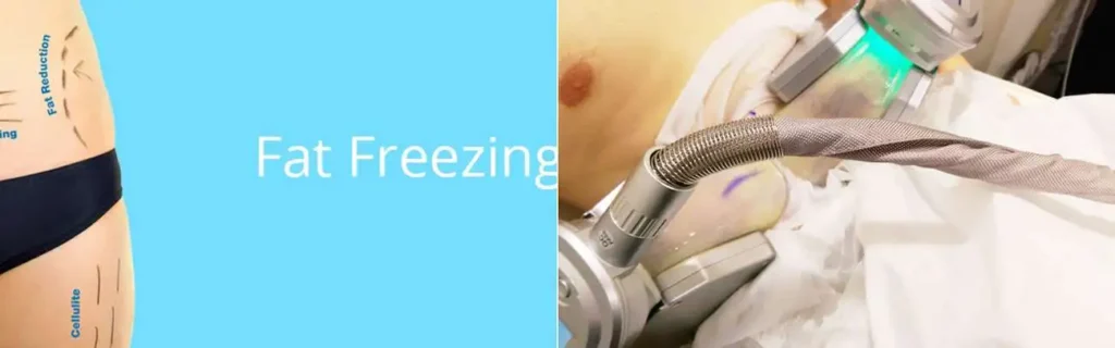 Fat freezing Chiswick on multiple areas of the body