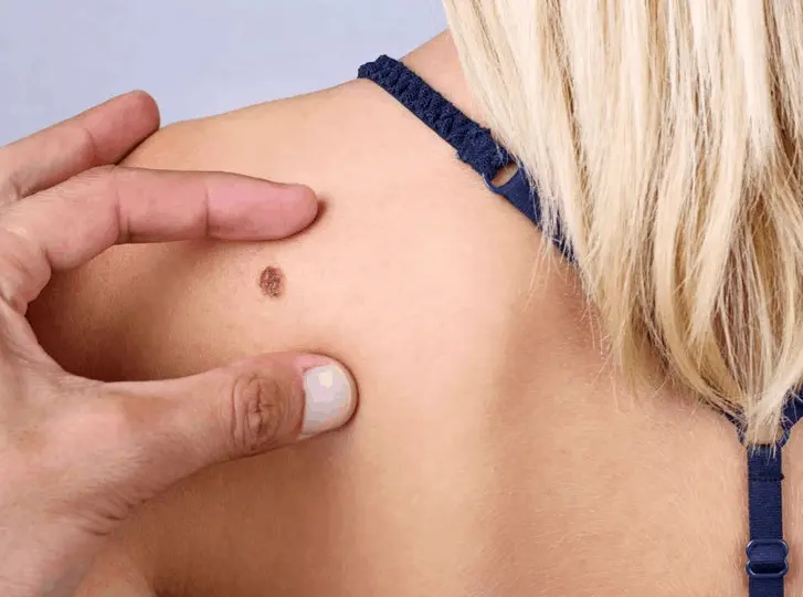 woman having mole removal Chiswick consultation before treatment.
