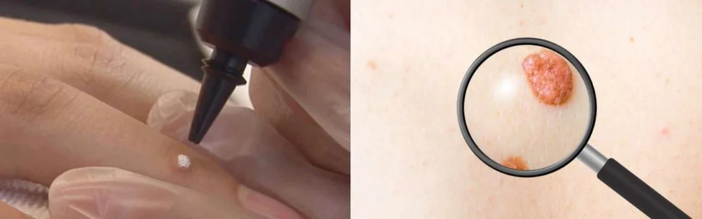 CryoPen practitioner Chiswick assessing a benign mole before treatment