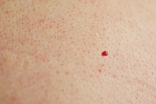 close up of a cherry angioma Chiswick