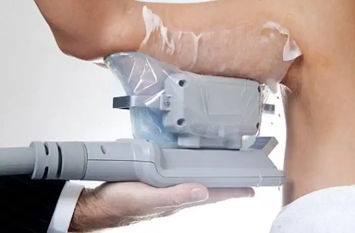 Picture of fat freezing Chiswick on the upper arms.