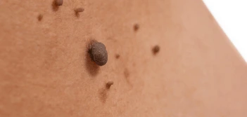 image of a skin tag Chiswick