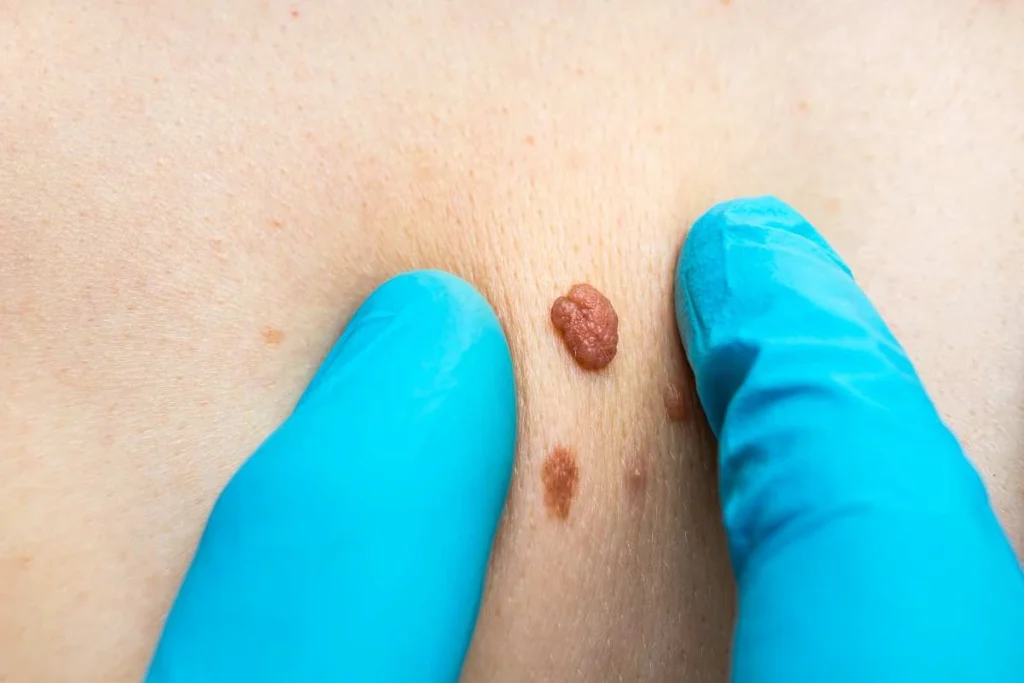 Consultant examining a skin tag Chiswick