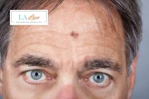 Solar Lentigo Removal Chiswick image of man with mark on his forehead
