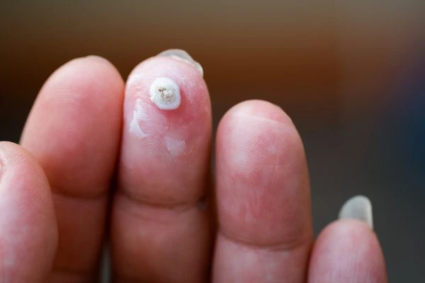 wart on person finger - cryotherapy to treat from LA LIPO Chiswick