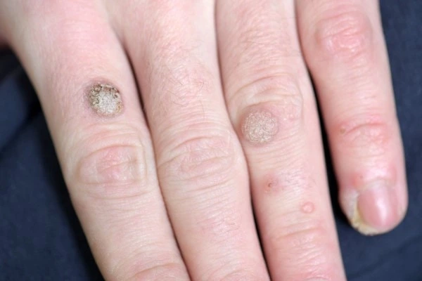 photo of warts on person hand - see wart removal Chiswick from LA LIPO