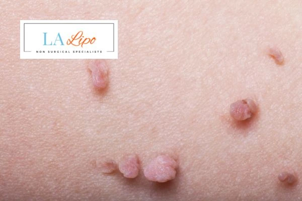 Does cryopen skin tag removal Chiswick hurt? Find out now call our team today!