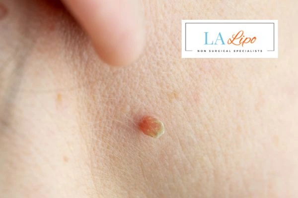 Book skin tag removal Chiswick today speak to our team now!