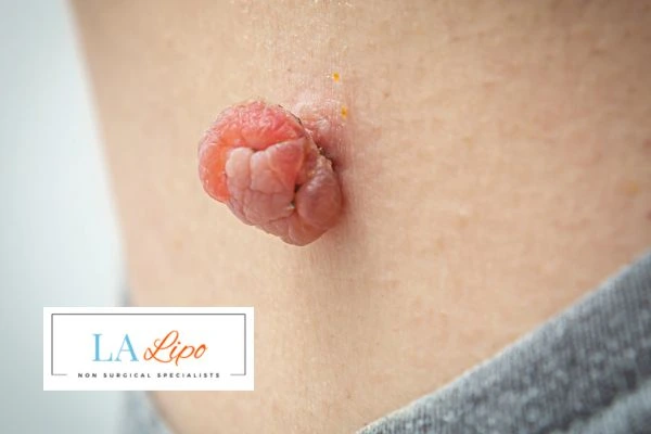 Interested in skin tag removal Chiswick? Concerned about the pain? Find out more today!
