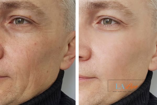 See the amazing results of Morpheus8 Treatment Chiswick!