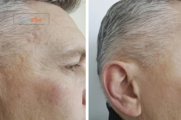 Mens Before & After Morpheus 8 Results Chiswick