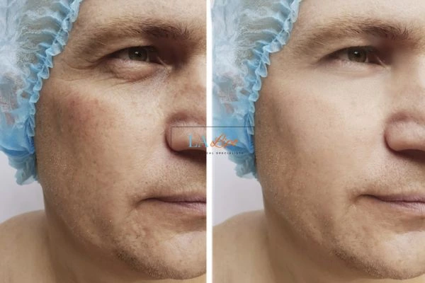 Before and after Morpheus 8 Results Chiswick