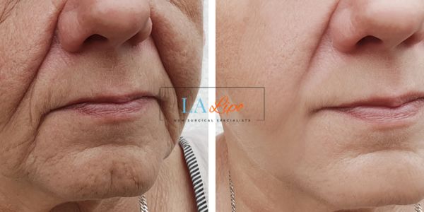 Older lady deeper wrinkle reduction - LA LIPO Morpheus 8 Results Chiswick