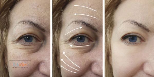 Amazing eye lift Morpheus 8 results Chiswick