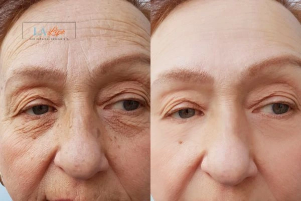 The powerful benefits of Morpheus8 Treatment Chiswick - Call Our team today!