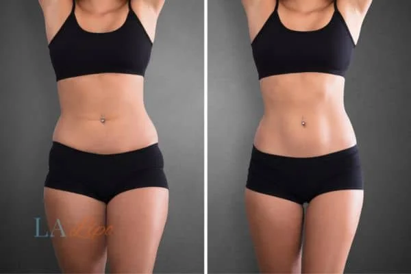 before and after results of non-surgical treatment to help a woman's body image and mental health Chiswick