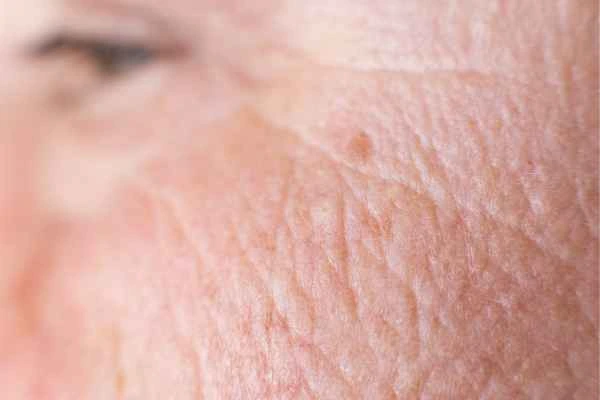 close up picture of a woman's face showing an age spot Chiswick