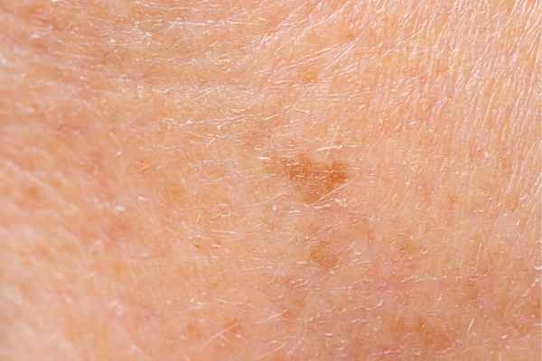 close up picture of age spots Chiswick