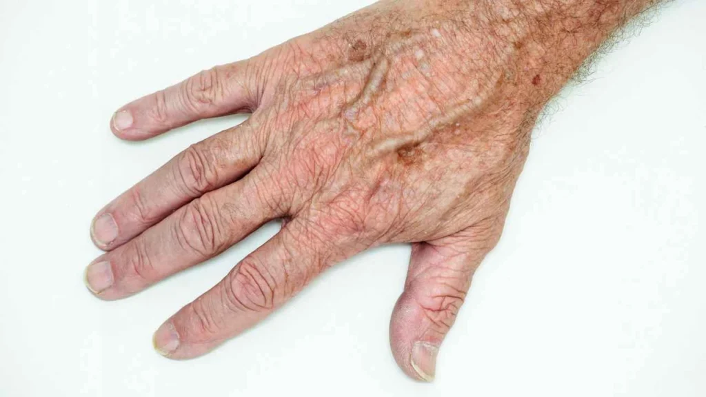Male hand showing age spot Chiswick