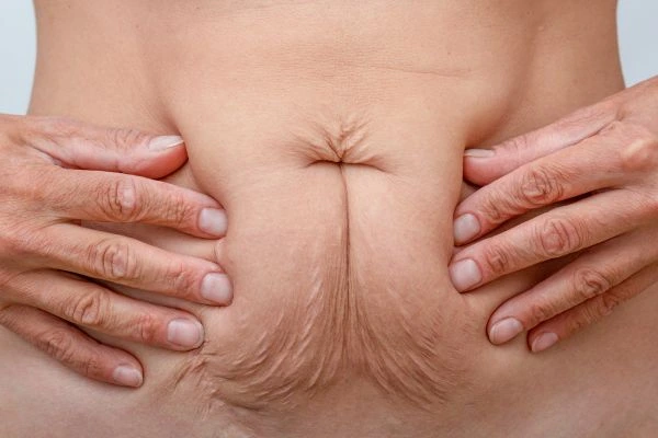 Image of a woman's stomach with loose skin - example of skin tightening Chiswick options